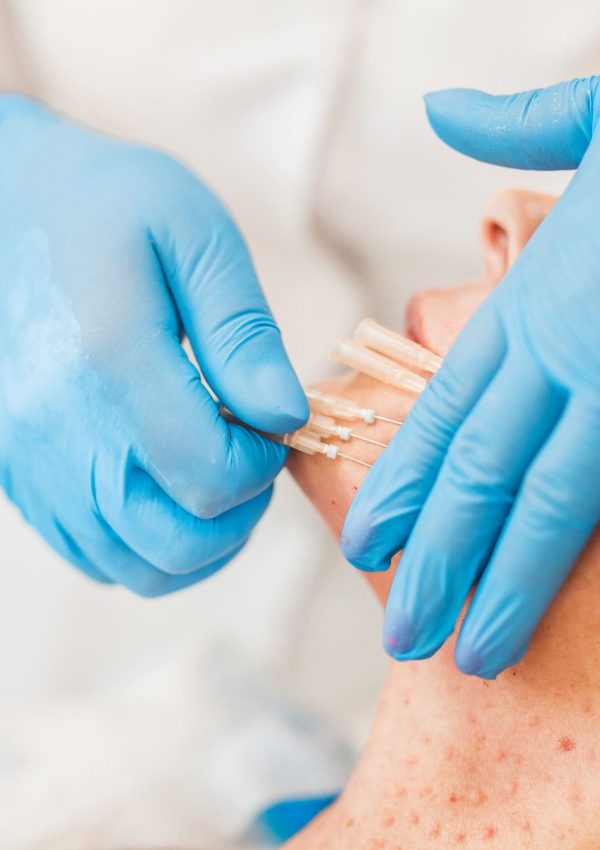 Thread,Lifting,-,The,Task,Of,Biostimulating,Monofilaments,-,Stimulation