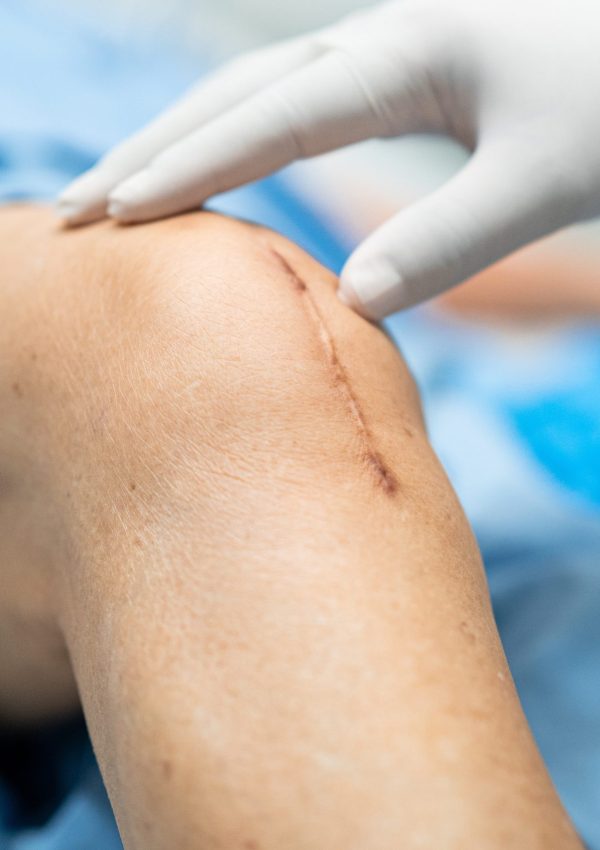 Asian,Elderly,Woman,Patient,Show,Her,Scars,Surgical,Total,Knee