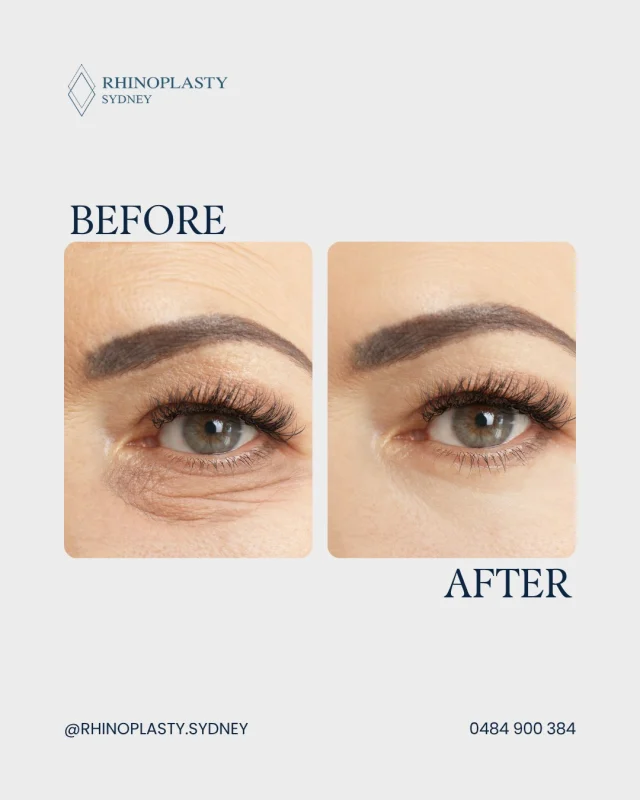 Lower eyelid adjustments focus on functional support and smooth contour.

This case highlights lower eyelid blepharoplasty to address under-eye fullness or minor sagging, helping eyelids rest comfortably against the eye while keeping natural shape.

Learn more about this procedure on our website: rhinoplastysydney.com.au

Disclaimer: 

Any surgical or invasive procedure carries risks. See our dedicated Risks and Complications page for full details on general and procedure specific risks, recovery timelines, and outcome variations. Before proceeding, you should seek a second opinion from an appropriately qualified health practitioner.

Individual results, healing, recovery, and risks vary between patients. Before and after images on this page are authentic and unedited but are not a guarantee that your results will be the same or similar to any other individual’s outcomes. Factors such as anatomy, skin type, age, and lifestyle may influence what is achievable.

All surgical procedures on this page are performed by Dr Mooney, MBBS, a fully qualified and registered specialist ENT/Head and Neck Surgeon (AHPRA MED0001145166). We ensure full patient consent, see patients at least twice before surgery, observe an appropriate cooling off period, and welcome you seeking a second opinion from a colleague. The content on this page is general in nature and does not constitute medical advice. 

You can view more info regarding risks here www.rhinoplastysydney.com.au/risks 

For personalised information, book a consultation.

#rhinoplastysydney #drwillmooney #blepharoplasty #LowerEyelidSurgery #blepharoplastysurgery