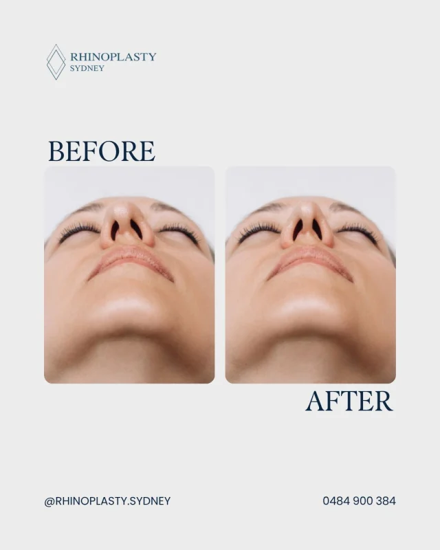 A closer look at how structural nasal adjustments can change overall balance.

This case shows a primary rhinoplasty where adjustments were made to the nasal bridge and tip support. The focus was on refining structure while maintaining the patient’s natural features.

Each rhinoplasty is planned according to nasal anatomy, breathing function, and long-term structural stability.

Learn more about this procedure on our website: rhinoplastysydney.com.au

Disclaimer: 

Any surgical or invasive procedure carries risks. See our dedicated Risks and Complications page for full details on general and procedure specific risks, recovery timelines, and outcome variations. Before proceeding, you should seek a second opinion from an appropriately qualified health practitioner.

Individual results, healing, recovery, and risks vary between patients. Before and after images on this page are authentic and unedited but are not a guarantee that your results will be the same or similar to any other individual’s outcomes. Factors such as anatomy, skin type, age, and lifestyle may influence what is achievable.

All surgical procedures on this page are performed by Dr Mooney, MBBS, a fully qualified and registered specialist ENT/Head and Neck Surgeon (AHPRA MED0001145166). We ensure full patient consent, see patients at least twice before surgery, observe an appropriate cooling off period, and welcome you seeking a second opinion from a colleague. The content on this page is general in nature and does not constitute medical advice. 

You can view more info regarding risks here www.rhinoplastysydney.com.au/risks 

For personalised information, book a consultation.

#rhinoplastysydney #drwillmooney #SydneyClinics #rhinoplasty #consultation #ENT